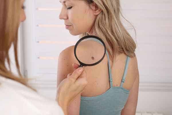 What Are Traditional Skin Lesion Removal Methods Cockfosters?