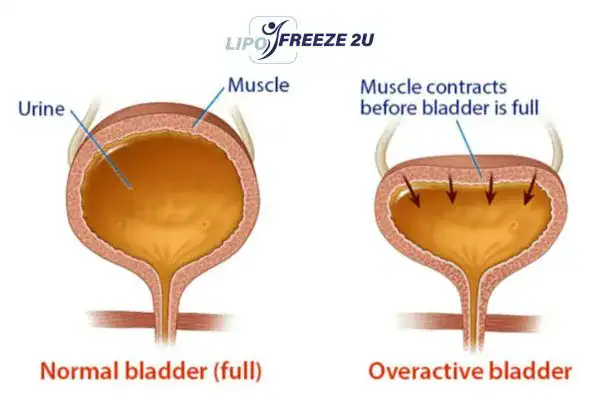 diagram of overactive bladder treatment Cockfosters
