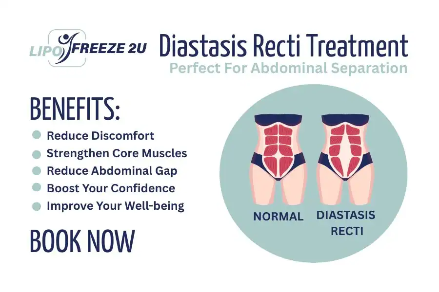 How Long Will It Take to See Improvements in Diastasis Recti Cockfosters