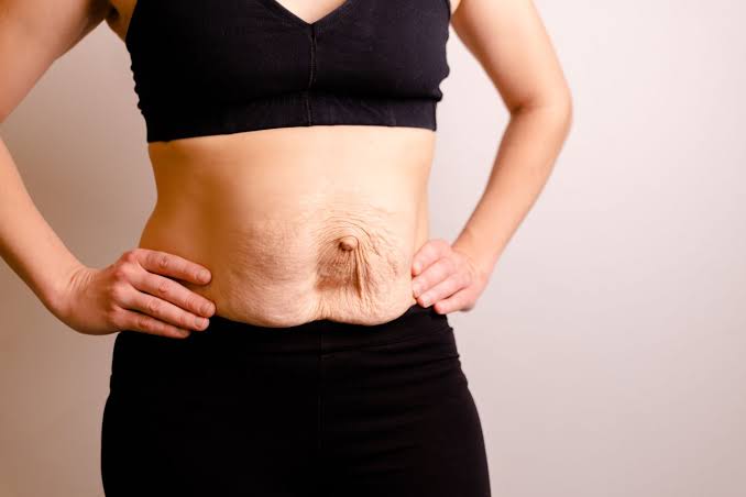 Is Surgery Really the Only Way to Repair Diastasis Recti Cockfosters?