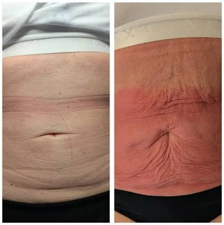 How Does RF Microneedling Improve Crepey, Thin and Uneven Skin Texture Cockfosters?