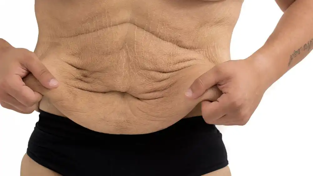 RF Microneedling for Loose Skin: How Can It Help Tighten and Reshape the Skin Cockfosters?